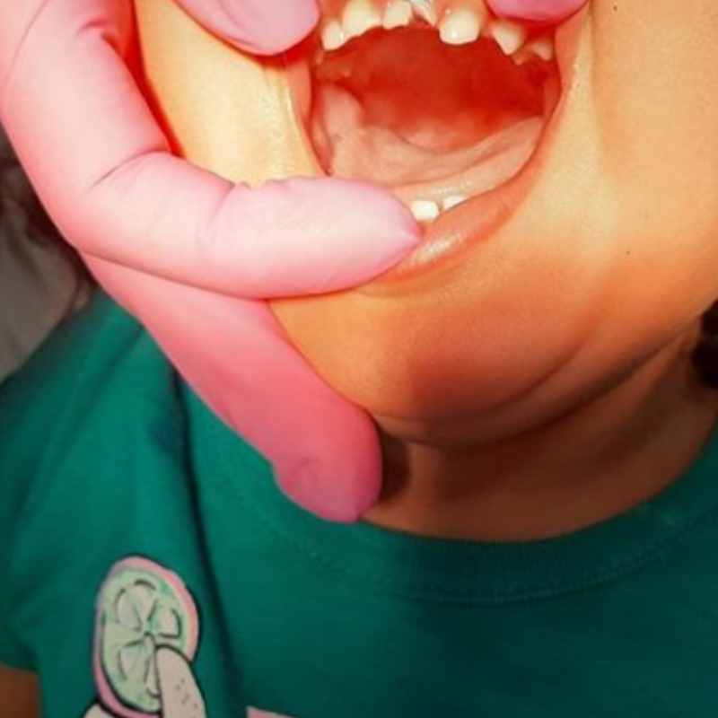 TRAUMATISMO DENTÁRIO